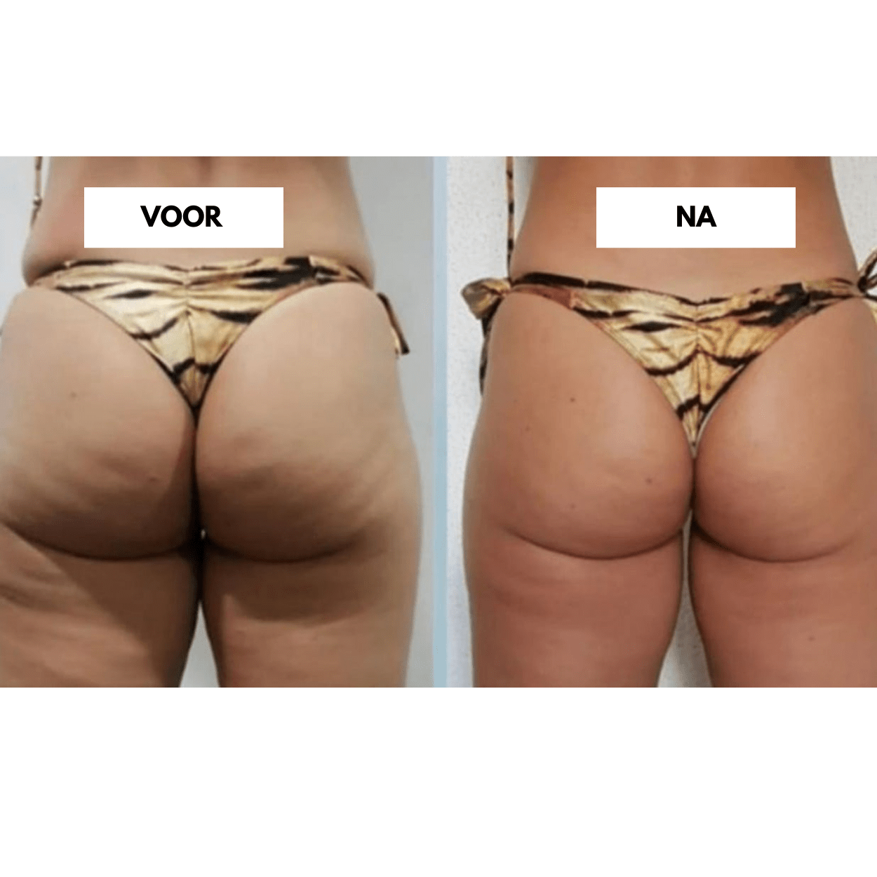 CelluCare Anti-Cellulite Gerät